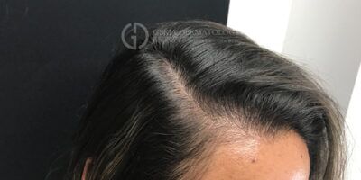 PRP Hair Restoration case #2222