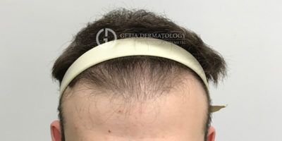 PRP Hair Restoration case #2205