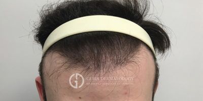 PRP Hair Restoration case #2205