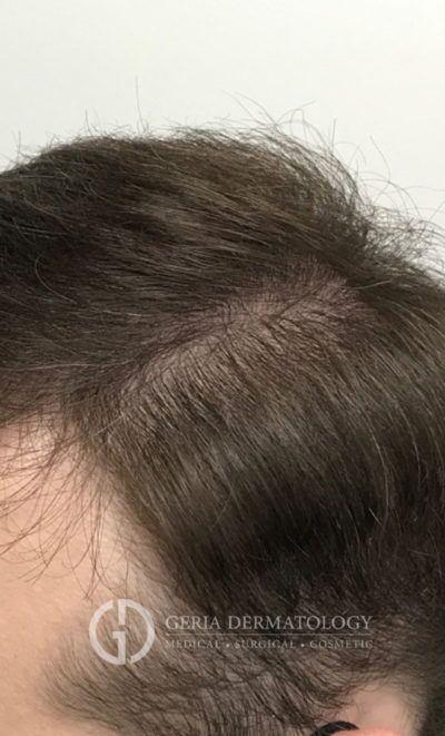PRP Hair Restoration case #2205