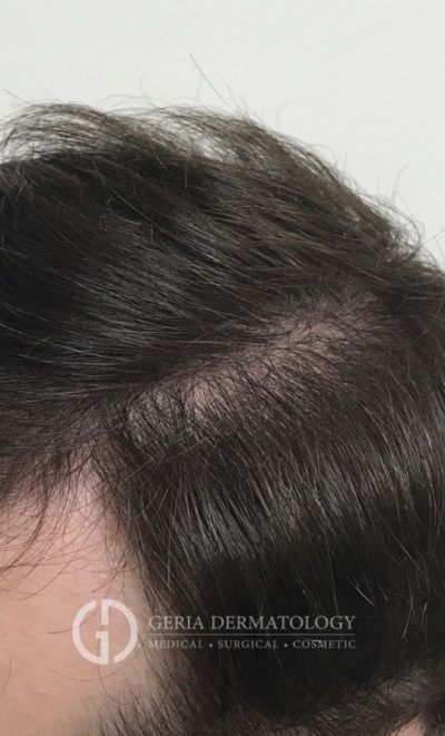 PRP Hair Restoration case #2205