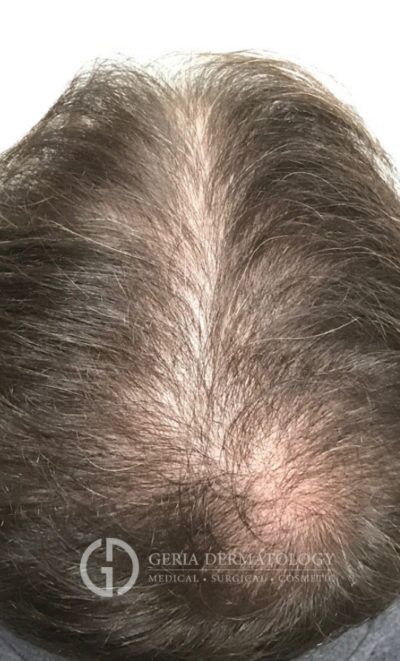 PRP Hair Restoration case #2205