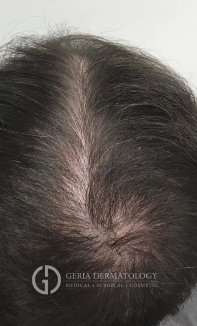 PRP Hair Restoration case #2205