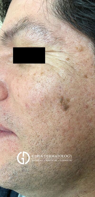 Seborrheic Keratosis Removal case #2243