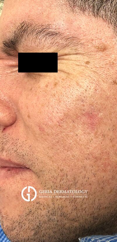 Seborrheic Keratosis Removal case #2243