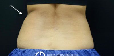 CoolSculpting case #1622