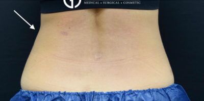 CoolSculpting case #1622