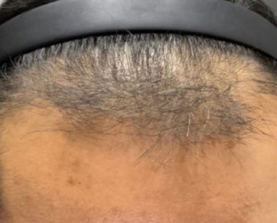 Hair Restoration Before and After Results | Geria Dermatology New Jersey