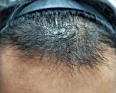 Hair Restoration Before and After Results | Geria Dermatology New Jersey