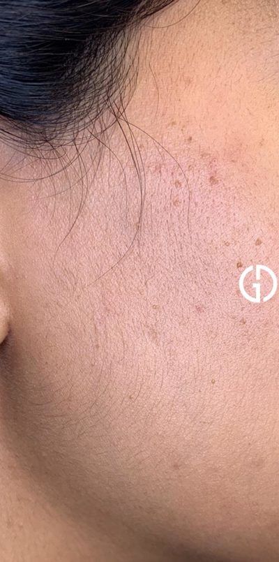 Dermaplaning case #1921
