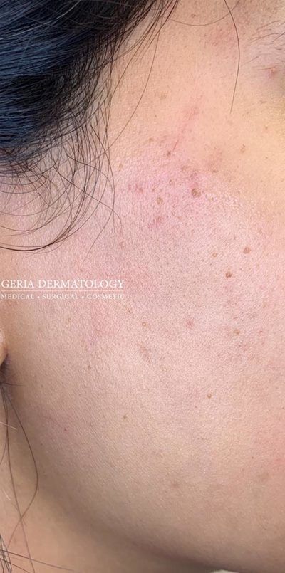 Dermaplaning case #1921