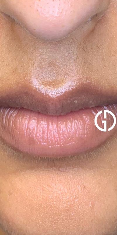 Dermaplaning case #1921