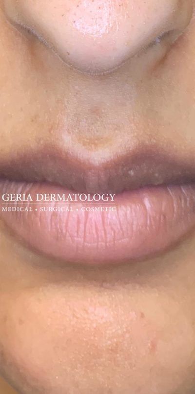 Dermaplaning case #1921