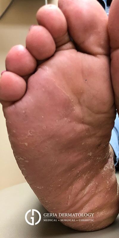 Psoriasis Treatment case #2237