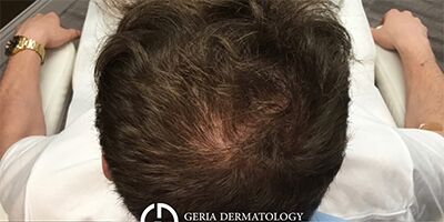 PRP Hair Restoration case #2166