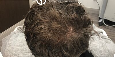 PRP Hair Restoration case #2166