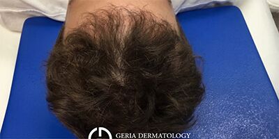 PRP Hair Restoration case #2166
