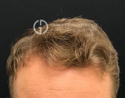 PRP Hair Restoration case #2215