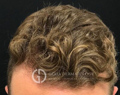 PRP Hair Restoration case #2215