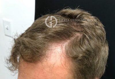 PRP Hair Restoration case #2215