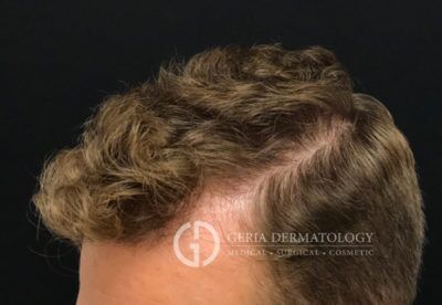 PRP Hair Restoration case #2215