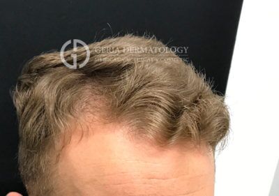 PRP Hair Restoration case #2215