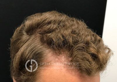 PRP Hair Restoration case #2215