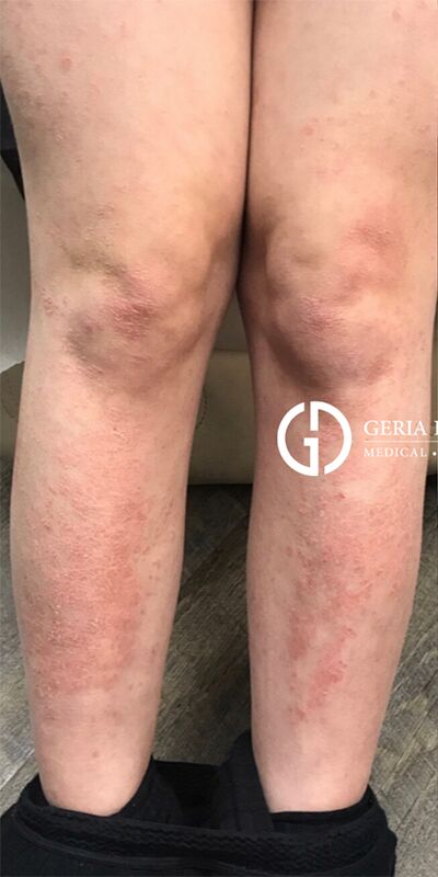 Psoriasis Treatment case #2228