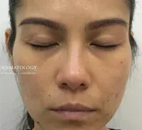 before and after dermatology treatment | Geria Dermatology New Jersey