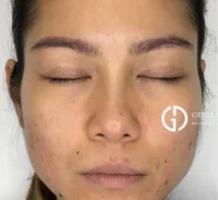 before and after dermatology treatment | Geria Dermatology New Jersey