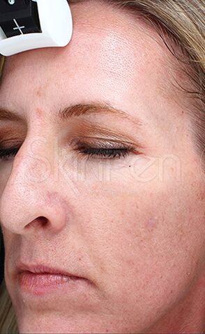 SkinPen Microneedling case #2260