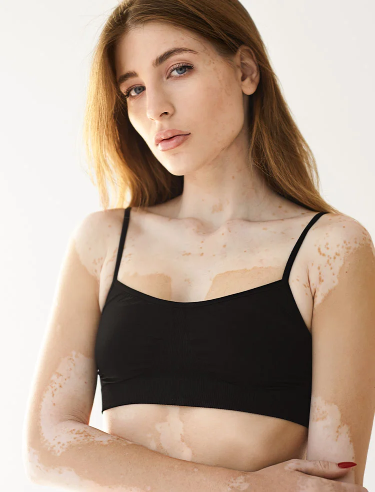 woman with vitiligo | Geria Dermatology New Jersey
