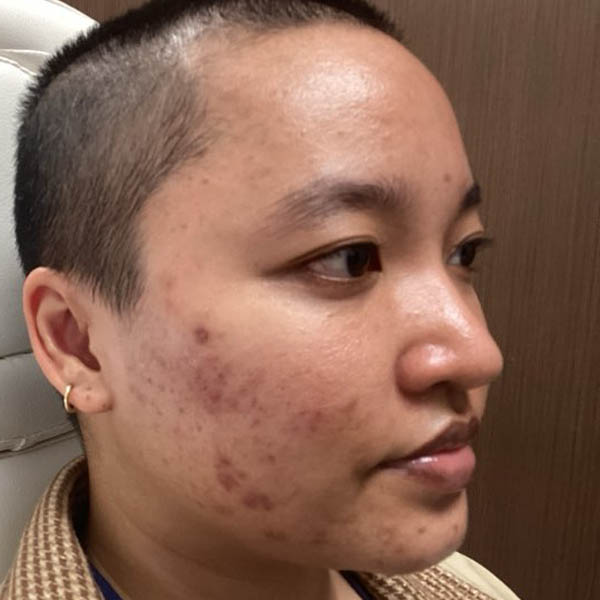 1_0000_Accutane Before (1).jpg