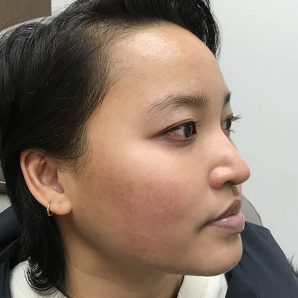 1_0001_Accutane After.jpg