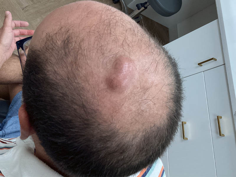 Cyst Removal case #48050