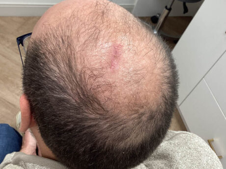 Cyst Removal case #48050