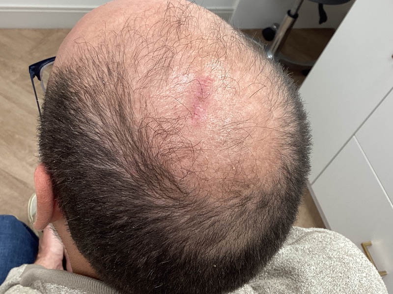 Cyst Removal case #48050