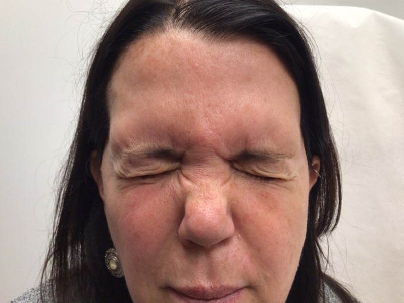 Nasolabial Fold Filler case #48053