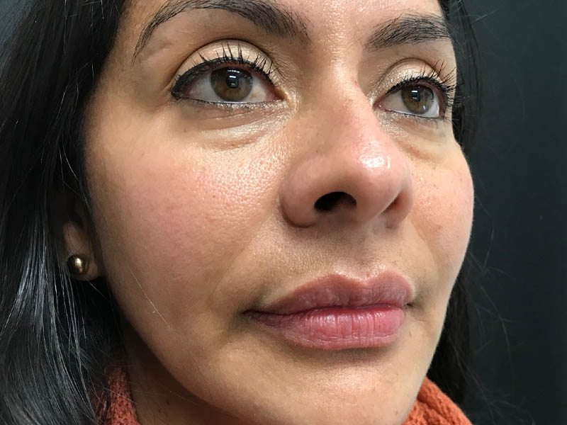 Nasolabial Fold Filler case #48056