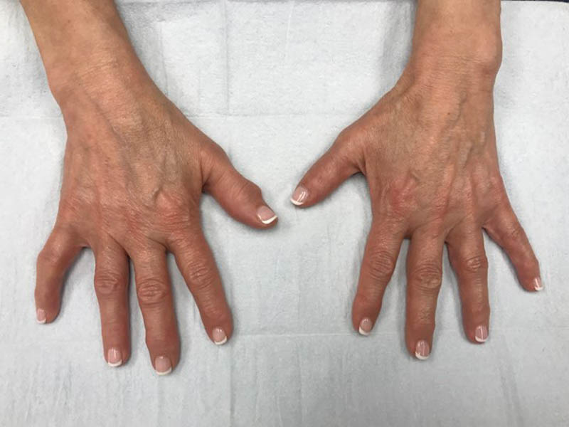 Hand Filler case #48059