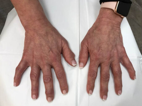 Hand Filler case #48059
