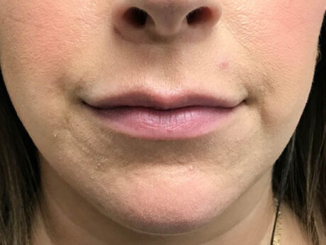 Lip Filler case #48071