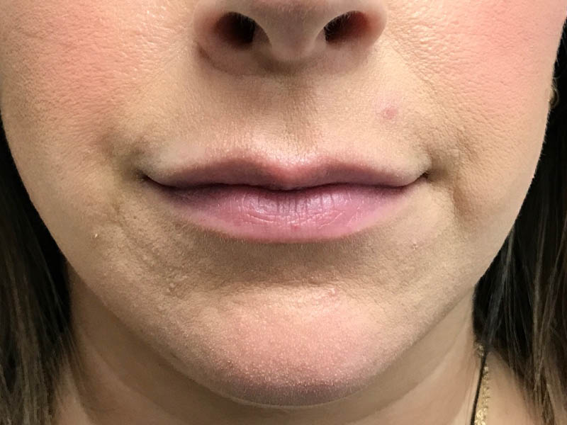 Lip Filler case #48071