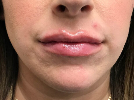 Lip Filler case #48071