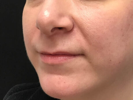 Lip Filler case #48074