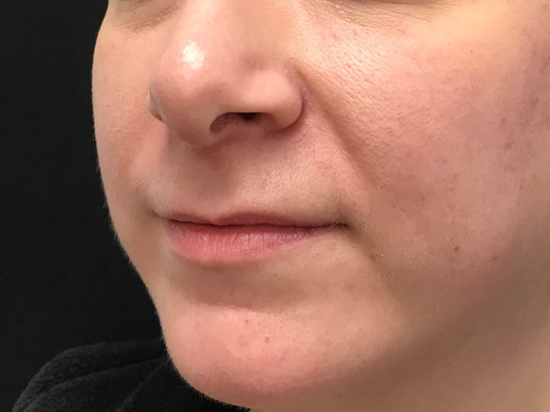 Lip Filler case #48074