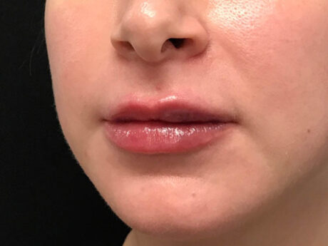 Lip Filler case #48074