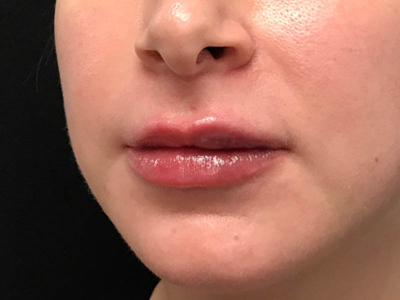 Lip Filler case #48074