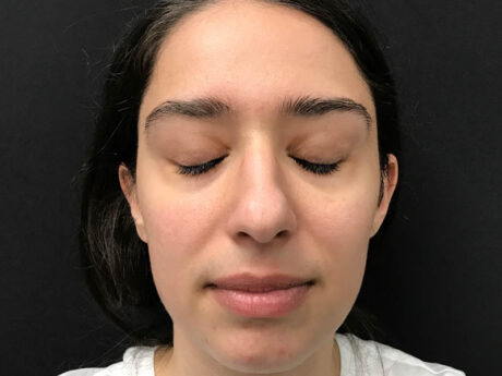 Lutronic Genius (RF Microneedling) case #48077