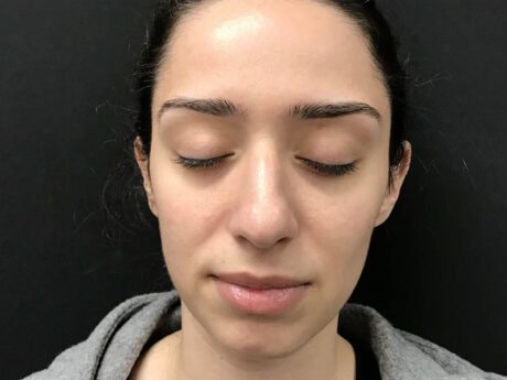 Lutronic Genius (RF Microneedling) case #48077